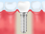 インプラント