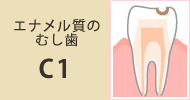 C1 エナメル質のむし歯