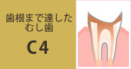 C4 歯根まで達したむし歯