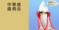 中等度歯周炎
